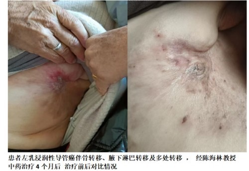 陈海林教授三焦气化法：开创乳腺癌治疗新路径